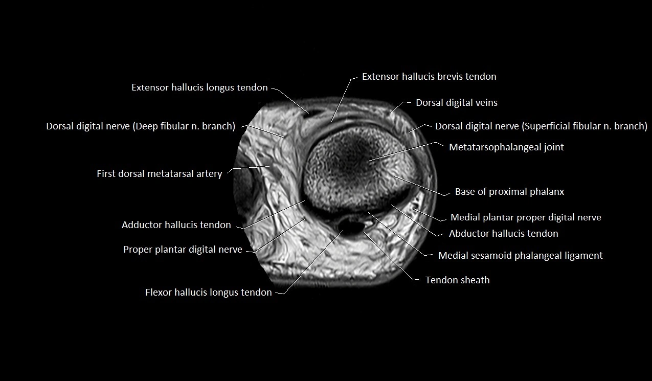 Great toe (hallux) axial microanatomy 3T MRI image 22.webp